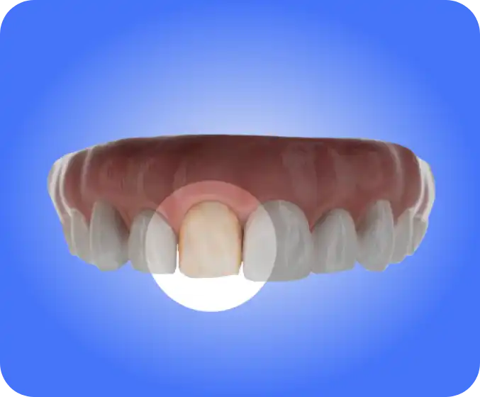 denti-gialli-faccette-studio-santia-piemonte-torino