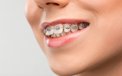 Ortodonzia a Torino: come correggere i denti storti