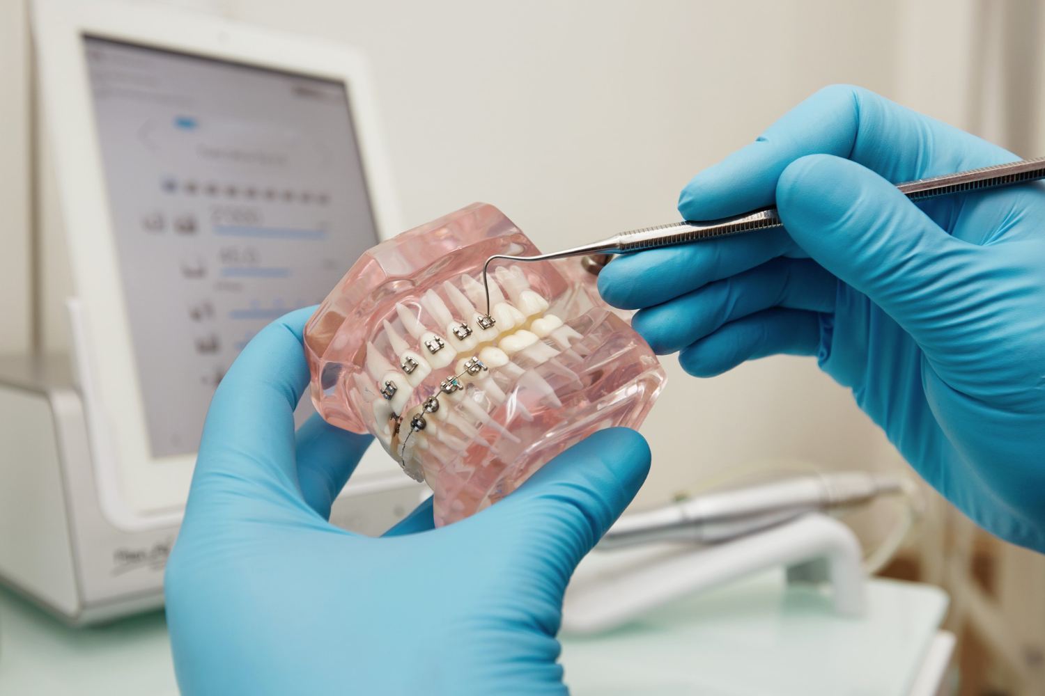 Impianto dentale che si muove o dondola: cosa fare?
